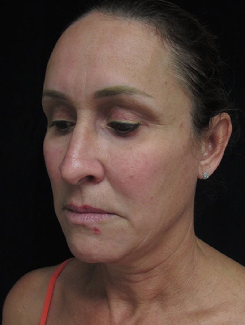 Face & Neck Lift Before & After Gallery - Patient 122908982 - Image 13