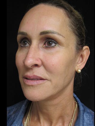 Face & Neck Lift Before & After Gallery - Patient 122908982 - Image 14