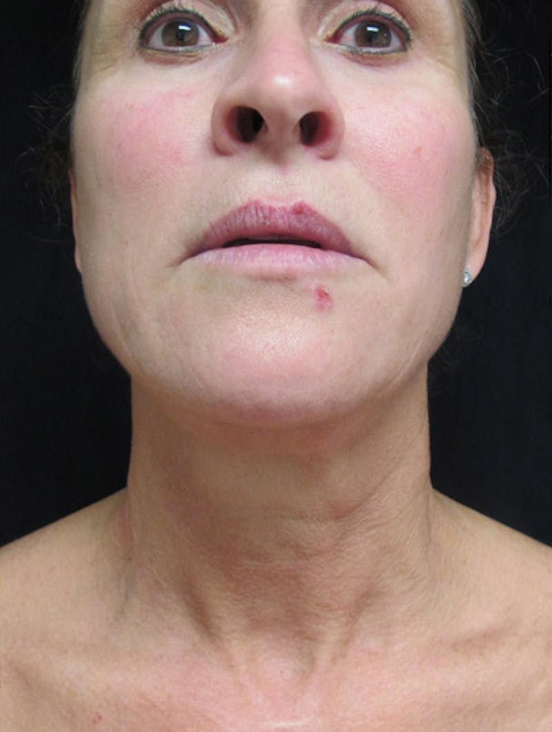 Face & Neck Lift Before & After Gallery - Patient 122908982 - Image 15