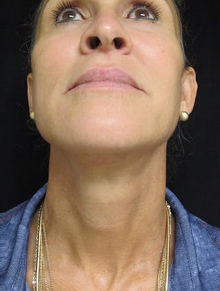 Face & Neck Lift Before & After Gallery - Patient 122908982 - Image 16