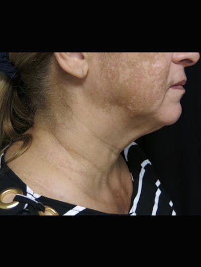 Face & Neck Lift Before & After Gallery - Patient 944730 - Image 1