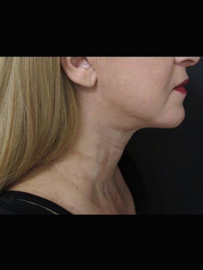 Face & Neck Lift Before & After Gallery - Patient 944730 - Image 2