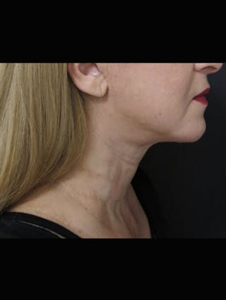 Face & Neck Lift Before & After Gallery - Patient 122908985 - Image 2