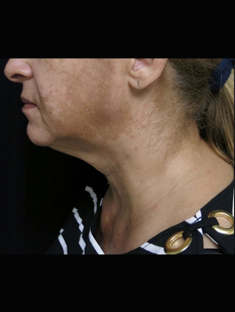 Face & Neck Lift Before & After Gallery - Patient 944730 - Image 3