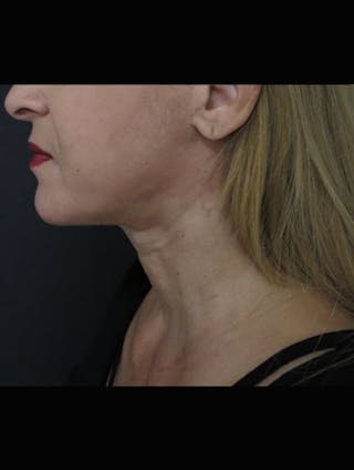 Face & Neck Lift Before & After Gallery - Patient 944730 - Image 4