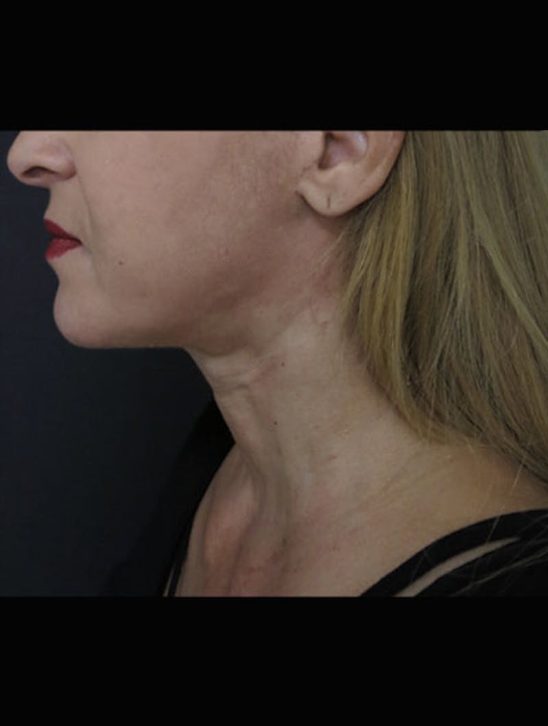 Face & Neck Lift Before & After Gallery - Patient 122908985 - Image 4