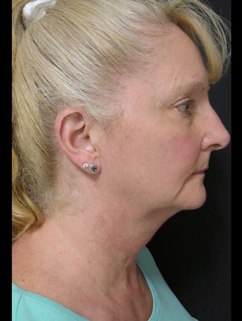Face & Neck Lift Before & After Gallery - Patient 122908991 - Image 1