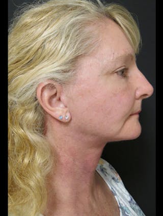 Face & Neck Lift Before & After Gallery - Patient 122908991 - Image 2