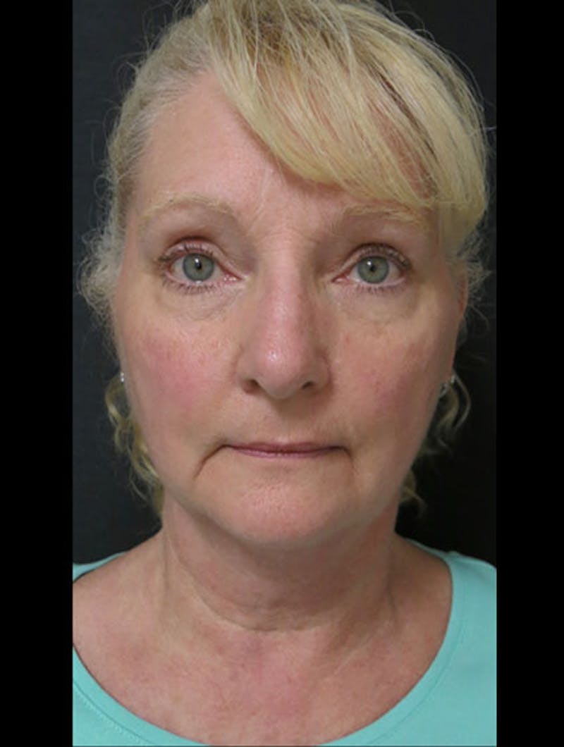 Face & Neck Lift Before & After Gallery - Patient 122908991 - Image 5