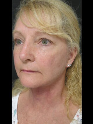 Face & Neck Lift Before & After Gallery - Patient 122908991 - Image 8