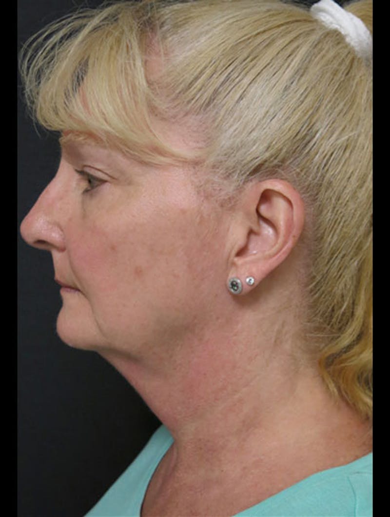 Face & Neck Lift Before & After Gallery - Patient 122908991 - Image 9