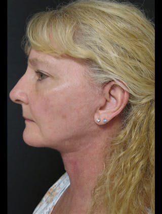 Face & Neck Lift Before & After Gallery - Patient 122908991 - Image 10