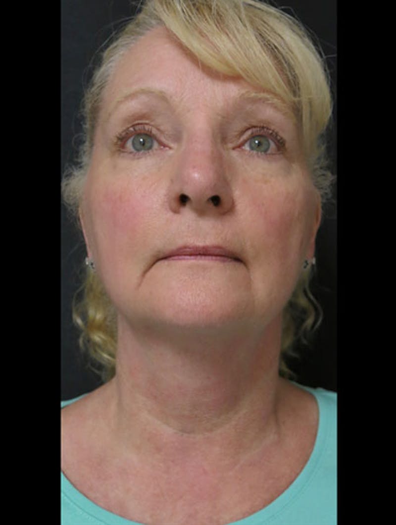 Face & Neck Lift Before & After Gallery - Patient 122908991 - Image 11