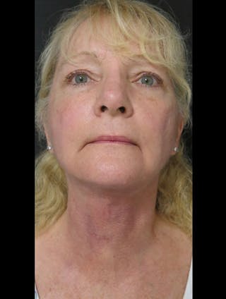 Face & Neck Lift Before & After Gallery - Patient 122908991 - Image 12