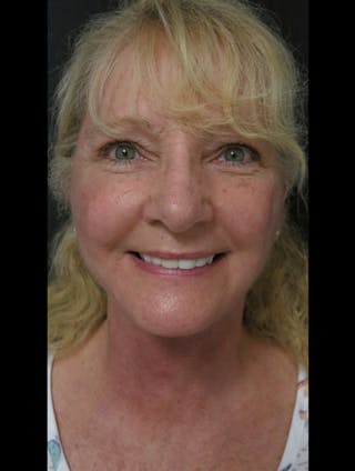 Face & Neck Lift Before & After Gallery - Patient 122908991 - Image 14