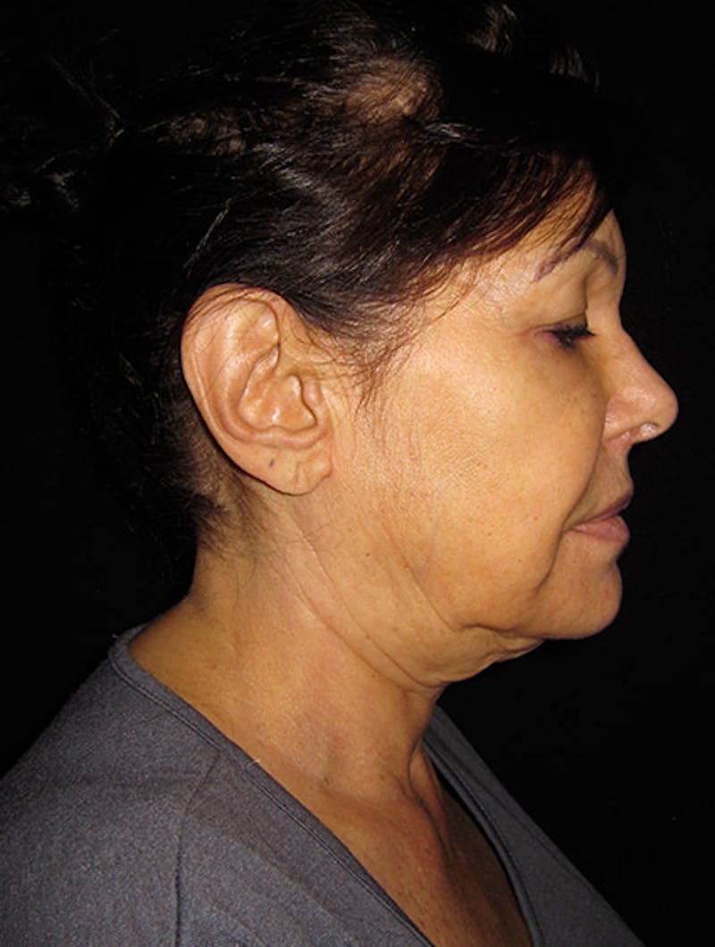 Face & Neck Lift Before & After Gallery - Patient 122908999 - Image 1