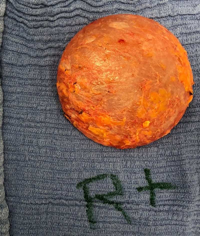 Breast Lift Before & After Gallery - Patient 122908996 - Image 32