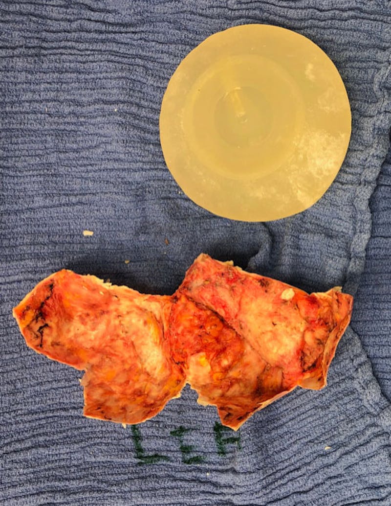 Breast Lift Before & After Gallery - Patient 122908996 - Image 33