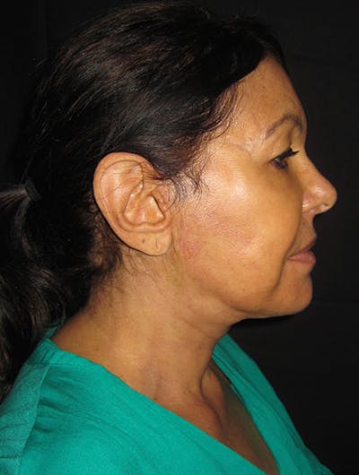 Face & Neck Lift Before & After Gallery - Patient 122908999 - Image 2