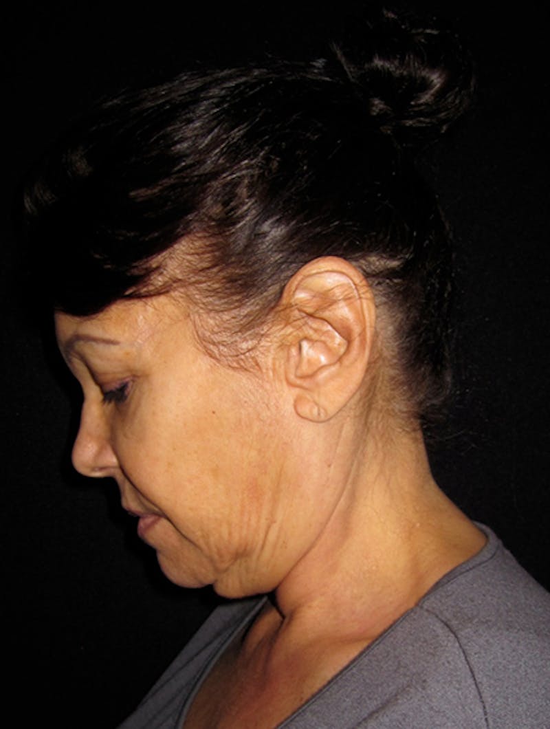 Face & Neck Lift Before & After Gallery - Patient 122908999 - Image 3
