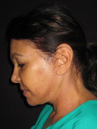 Face & Neck Lift Before & After Gallery - Patient 122908999 - Image 4