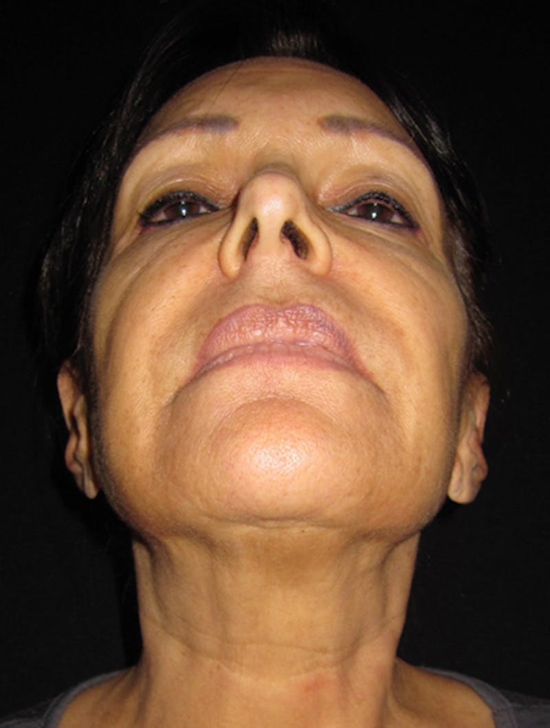 Face & Neck Lift Before & After Gallery - Patient 122908999 - Image 5