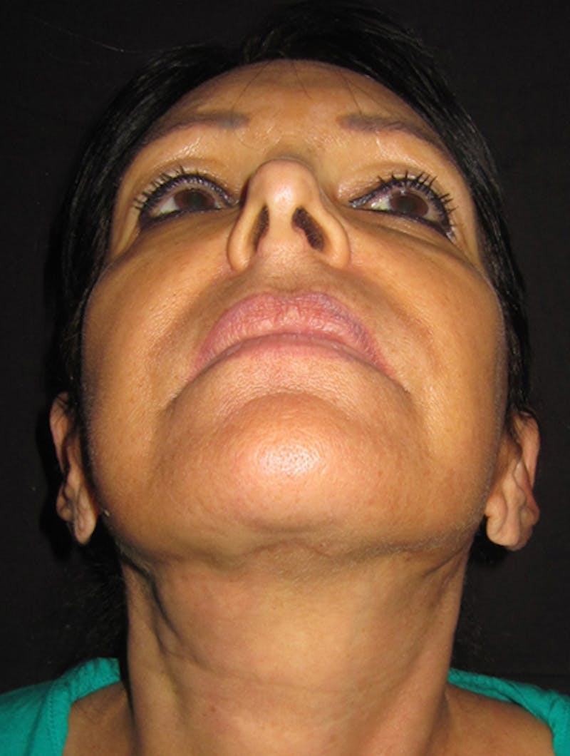 Face & Neck Lift Before & After Gallery - Patient 122908999 - Image 6