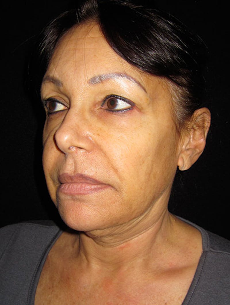 Face & Neck Lift Before & After Gallery - Patient 122908999 - Image 7