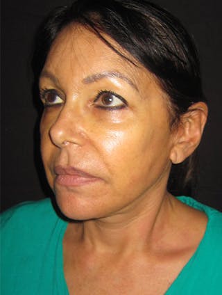 Face & Neck Lift Before & After Gallery - Patient 122908999 - Image 8