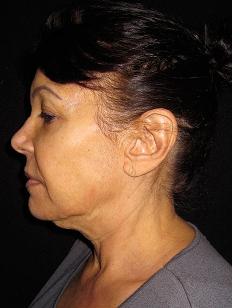 Face & Neck Lift Before & After Gallery - Patient 122908999 - Image 9