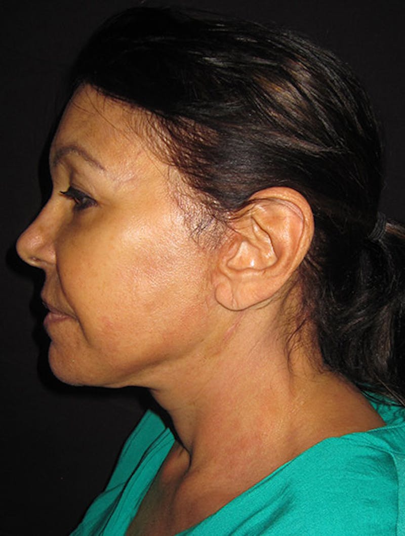 Face & Neck Lift Before & After Gallery - Patient 122908999 - Image 10