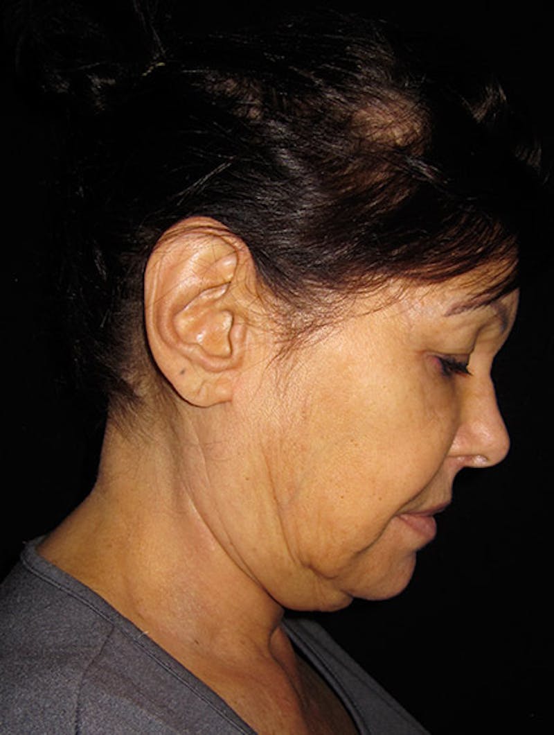 Face & Neck Lift Before & After Gallery - Patient 122908999 - Image 11