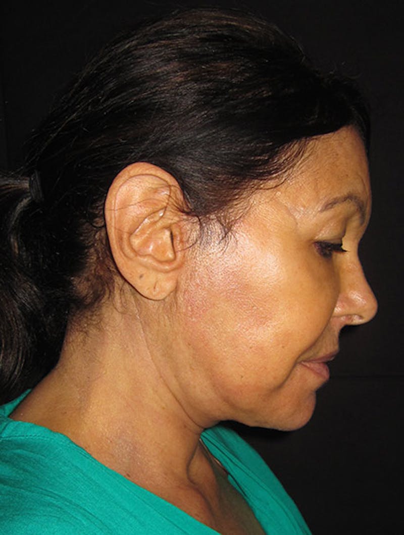 Face & Neck Lift Before & After Gallery - Patient 122908999 - Image 12