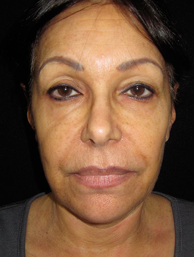 Face & Neck Lift Before & After Gallery - Patient 122908999 - Image 13
