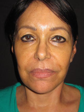 Face & Neck Lift Before & After Gallery - Patient 122908999 - Image 14