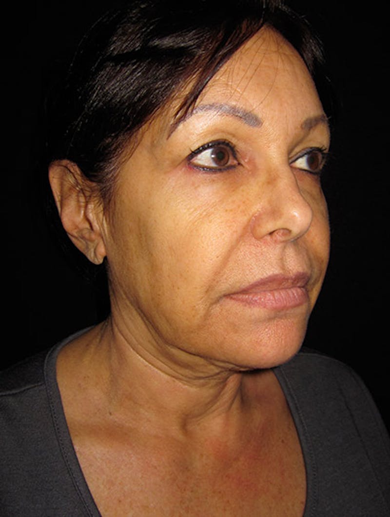 Face & Neck Lift Before & After Gallery - Patient 122908999 - Image 15