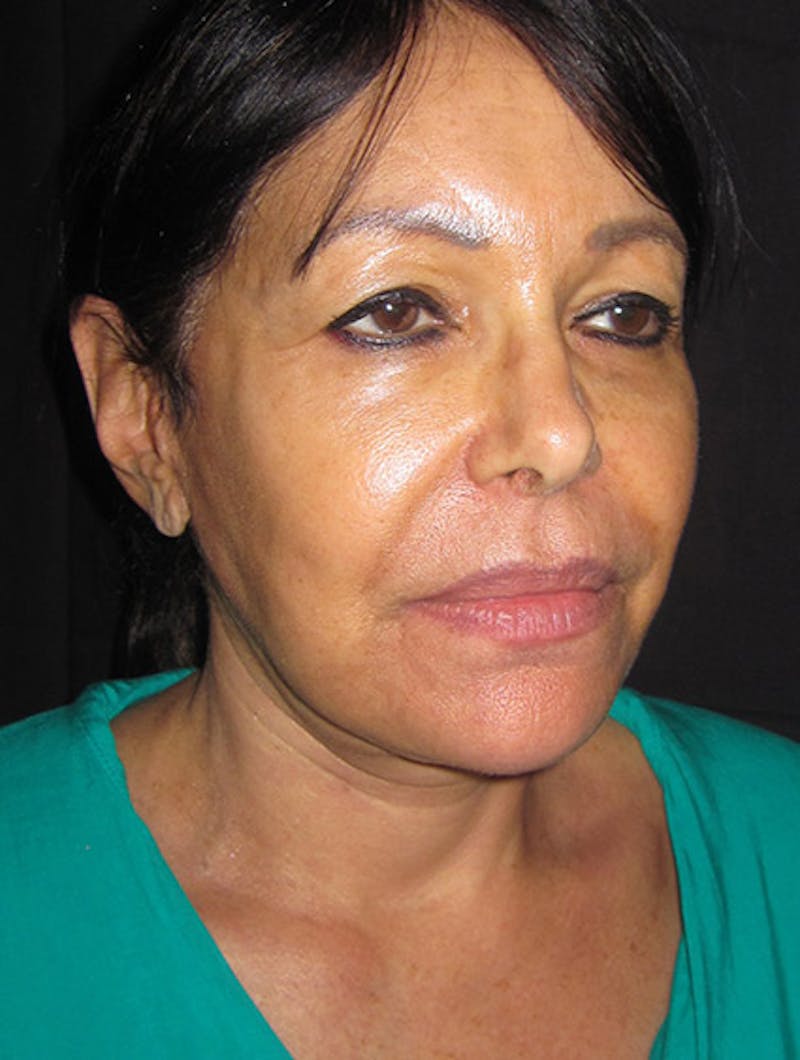 Face & Neck Lift Before & After Gallery - Patient 122908999 - Image 16