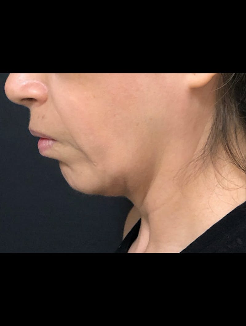 Face & Neck Lift Before & After Gallery - Patient 122909003 - Image 1