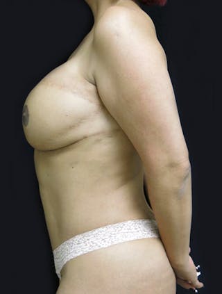 Breast Reconstruction Before & After Gallery - Patient 122909006 - Image 10