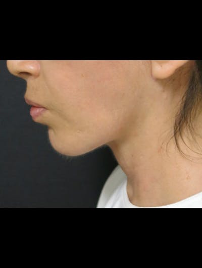 Face & Neck Lift Before & After Gallery - Patient 122909003 - Image 2