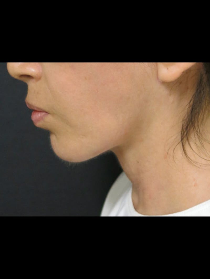 Face & Neck Lift Before & After Gallery - Patient 122909003 - Image 2