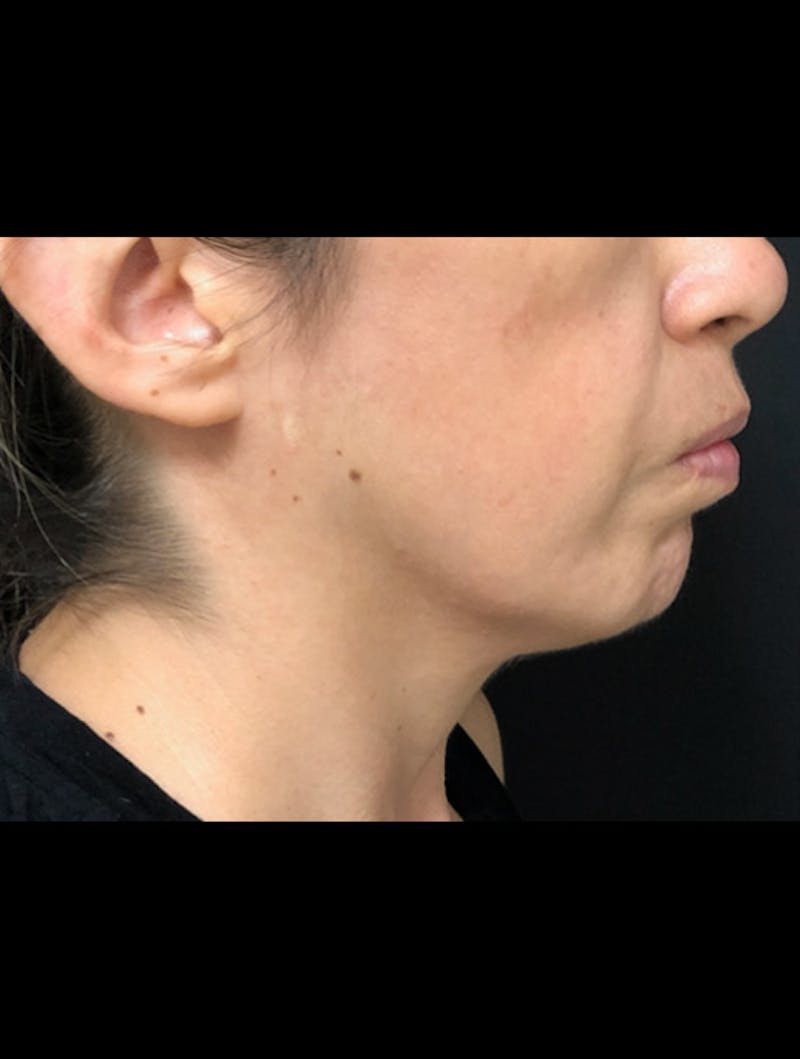 Face & Neck Lift Before & After Gallery - Patient 122909003 - Image 3