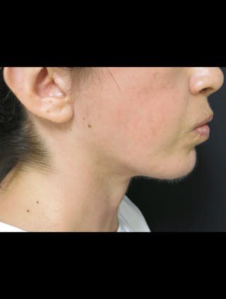 Face & Neck Lift Before & After Gallery - Patient 122909003 - Image 4