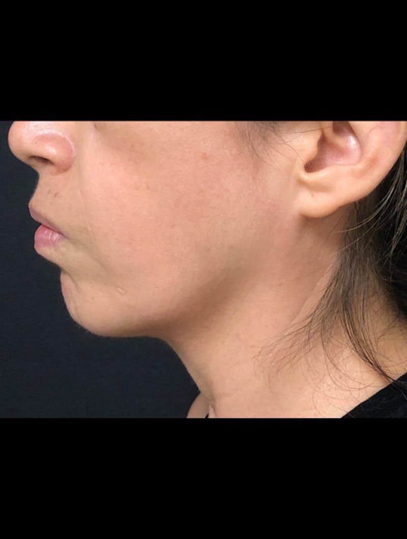 Face & Neck Lift Before & After Gallery - Patient 122909003 - Image 5