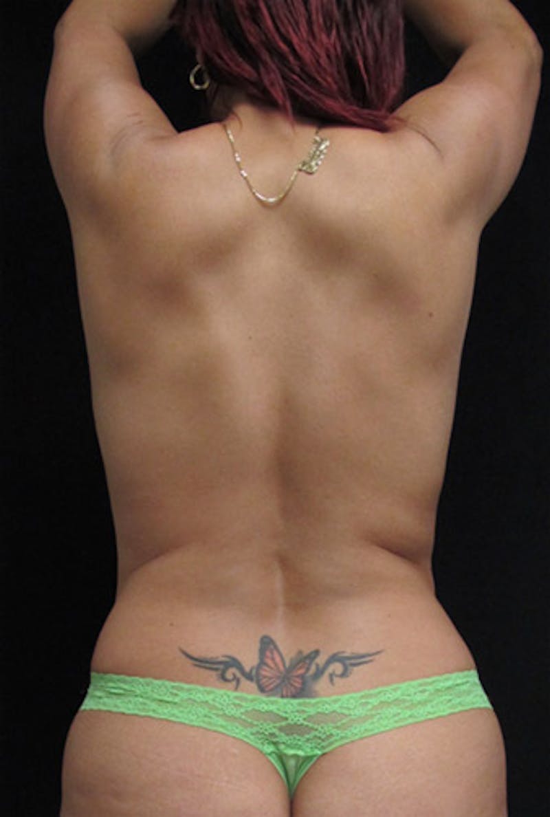 Breast Reconstruction Before & After Gallery - Patient 122909006 - Image 15