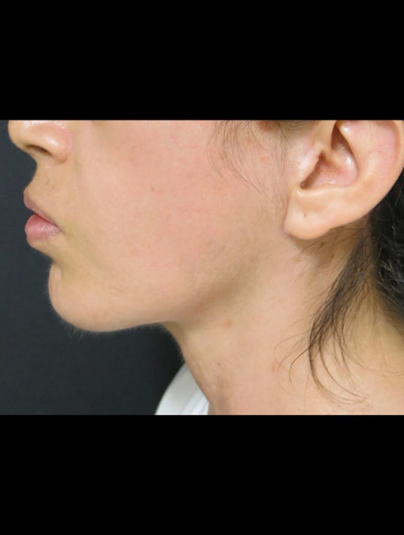 Face & Neck Lift Before & After Gallery - Patient 122909003 - Image 6