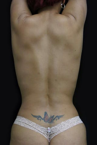 Breast Reconstruction Before & After Gallery - Patient 122909006 - Image 16