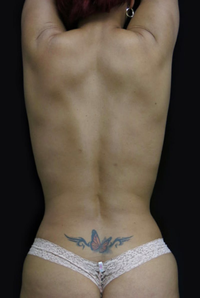 Breast Reconstruction Before & After Gallery - Patient 122909006 - Image 16