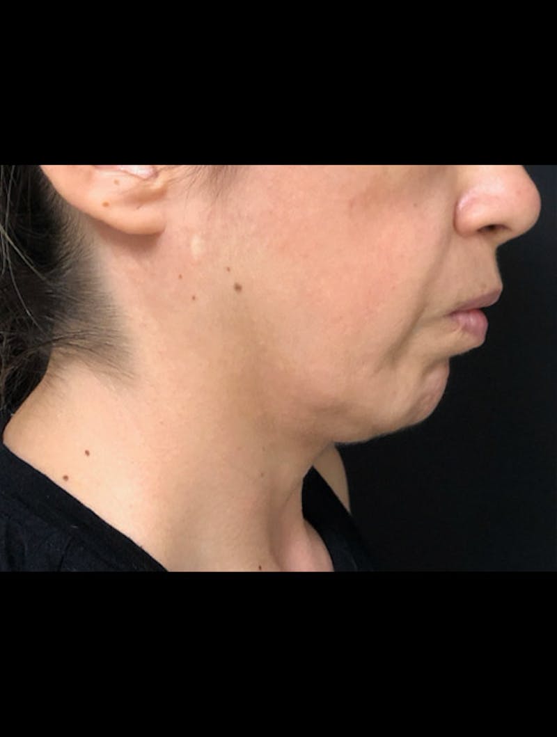 Face & Neck Lift Before & After Gallery - Patient 122909003 - Image 7