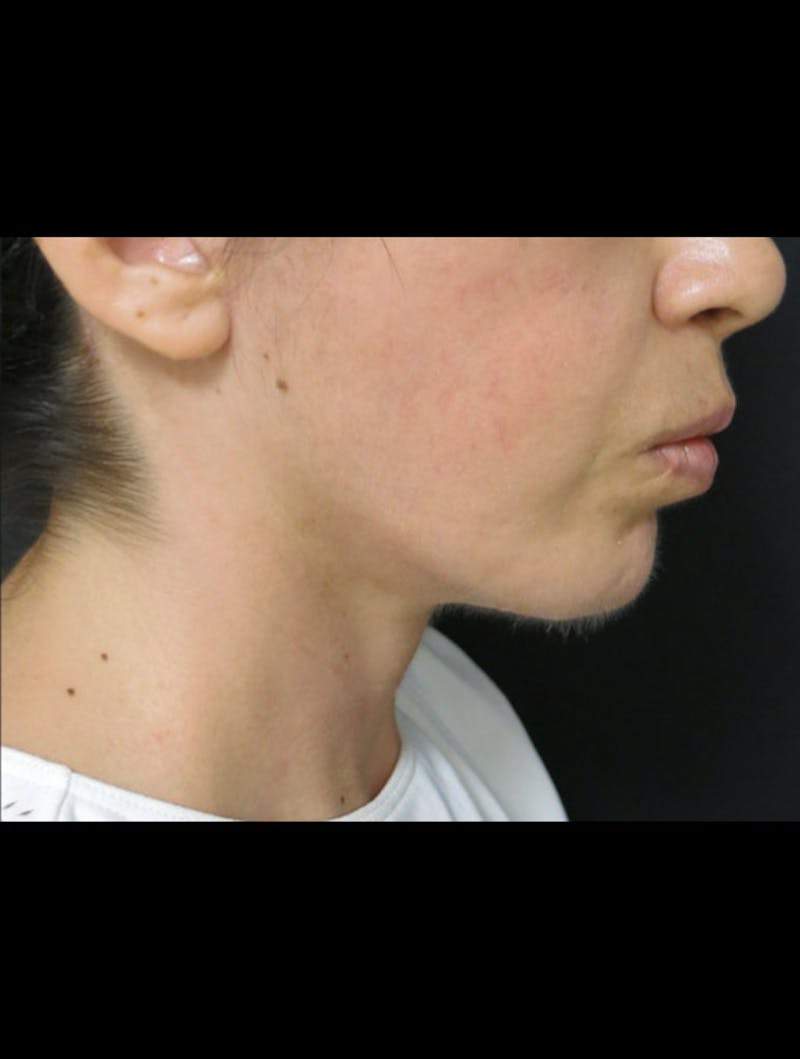 Face & Neck Lift Before & After Gallery - Patient 122909003 - Image 8